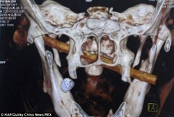 Ada Bambu Menancap di Kepala, Baru Ketahuan Setelah 8 Bulan!