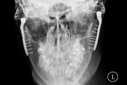 Mulut Tak Bisa Terbuka karena Stres, Implan Rp 315 Juta pun Dipasang