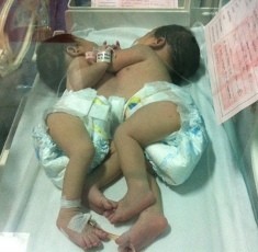 52 Dokter akan Tangani Operasi Bayi Kembar Siam di Surabaya