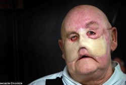 Raymond Martin, Wajahnya Tinggal Separuh karena Diserang Kanker Langka