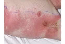 Sindrom Baboon, Komplikasi Langka Akibat Konsumsi Antibiotik