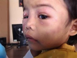 Balita Yatim di Pekanbaru ini Babak Belur, Diduga Dianiaya Bibinya