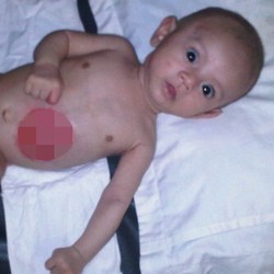 Tolong! Bayi 3 Bulan dari Pulau Tello di Nias Ini Tak Punya Anus