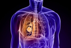  Kasus Kanker Paru-paru Pada Wanita Meningkat, Sedangkan Laki-Laki Menurun