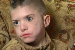 Bocah dengan Kelumpuhan Wajah Langka Ini Minta Kado Natal Berupa Senyum