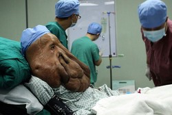 Masih Digelayuti Tumor Besar, Manusia Gajah Ini akan Kembali Dioperasi