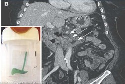 Tak Sengaja Telan Hiasan Kue Natal, Usus Wanita Ini Jadi Bolong