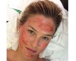 Hiii.. Bar Refaeli Wajahnya Penuh Darah Setelah Facial Vampire
