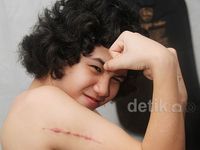 Ini Luka Dul Akibat Kecelakaan