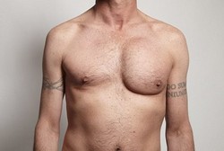 Ingin Keren dengan Dada Bidang, Implan Dada Pria Ini Malah Meledak