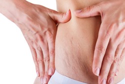 4 Bahan Alami untuk Hilangkan Stretch Mark di Kulit