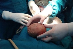 Batu Kandung Kemih Raksasa Hampir 1 Kg Bersarang di Tubuh Seorang Kakek