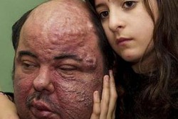 Ini Dia Luis Casaramona, Pria dengan Transplantasi Wajah Paling Rumit Sedunia