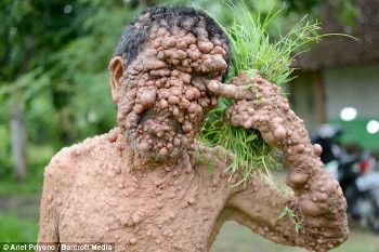 Slamet, Pria Asal Magetan yang Tubuhnya Dipenuhi Ratusan Tumor