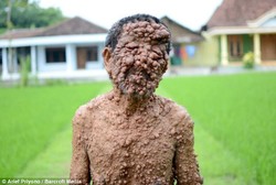 Ratusan Tumor Tumbuh di Wajah dan Tubuh Bikin Pria Ini Sulit Napas