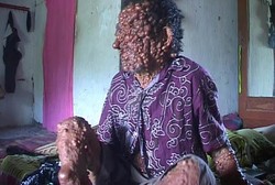 Tumor Makin Banyak, Pria Asal Magetan Ini Hanya Bisa Tergolek di Kasur