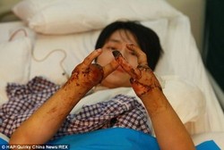 Akibat Kecelakaan Kerja, Remaja Ini Hanya Punya Tangan dengan 2 Jari