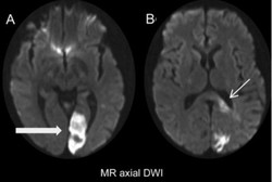 Akibat Serangan Stroke, Perempuan Ini Mendadak Buta Aksara
