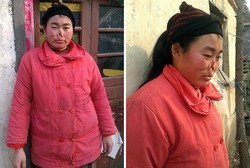 Gara-gara Digerogoti Tikus Saat Bayi, Wanita Ini Tak Punya Cuping Hidung