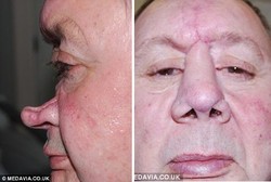 Kena Kanker Kulit, Alan Sempat Tak Punya Hidung Selama Dua Tahun