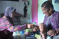 Tumor di Wajah Manusia Gelembung dari Magetan Mulai Dioperasi