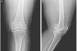 Dikira Rematik, Ratusan Jarum Emas Ditemukan di Lutut Perempuan Korsel