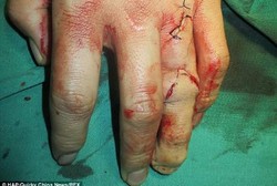 Jari Manis Pemuda Ini Terbuat dari Jari Kakinya 