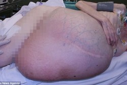 Perut Wanita Ini Membengkak 20 Kali Lipat karena Tumor 36 Kg