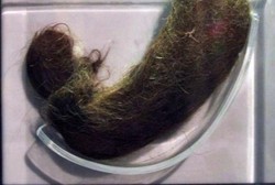 Kena Penyakit Aneh, Rambut Seberat 0,5 Kg Bersarang di Perut Seorang Gadis