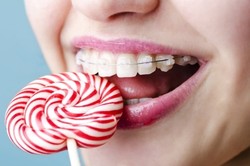 Pakai Kawat Gigi? Hindari Makan Popcorn dan Permen (1)