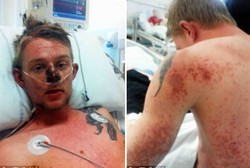 Pria Ini Koma 9 Hari dan Kulitnya Mengelupas Karena Alergi Obat Flu