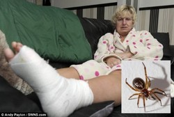 Digigit Laba-laba Saat Tidur, Wanita Ini Mengalami Infeksi Parah