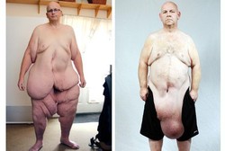 5 Korban Operasi Berat Badan, Lemak Hilang Tapi Tubuh Penuh Gelambir Kulit