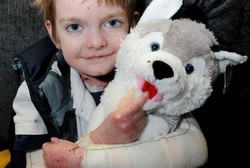 Kulitnya Luka dan Melepuh Jika Disentuh, Bocah 8 Tahun Ini Selalu Diperban