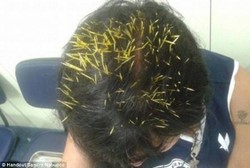 Duh, Kepala Wanita Ini Tertancap 272 Duri Setelah Kejatuhan Landak 