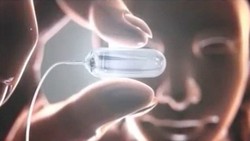 Tak Semua Percaya, Dokter Ini Tak Anjurkan Obalon untuk Turunkan Bobot