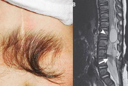 Tumbuh Rambut di Punggung, Tak Tahunya Gejala Penyakit Serius