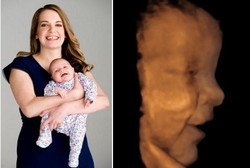 Berkat USG 3D, Wajah Bayi Alice Sudah Terlihat Meski di Dalam Kandungan