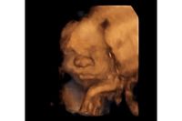 Alice, Bayi yang Sudah Lahir Meski Masih di Kandungan Berkat USG 3D