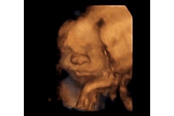 Alice, Bayi yang Sudah Lahir Meski Masih di Kandungan Berkat USG 3D