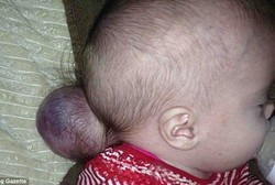 Bayi yang Sebagian Otaknya di Luar Kepala Akhirnya Bertahan Hidup