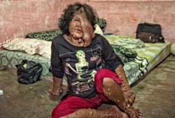 Sama Seperti Sarotin, Wajah Anaknya Juga Ditumbuhi Tumor