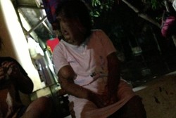 Wajah Sarotin Meleleh, Operasi Belum Tentu Selesaikan Masalah