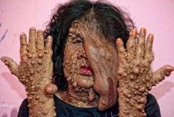 Tubuh Dipenuhi Tumor, Ini 5 Manusia Gelembung di Indonesia
