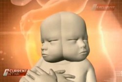 Bayinya Bakal Lahir 2 Wajah 1 Badan, Renee Tolak Gugurkan Kandungan