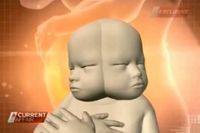 Renee Howie, Ibu dengan Calon Bayi 2 Wajah 1 Badan yang Tolak Aborsi