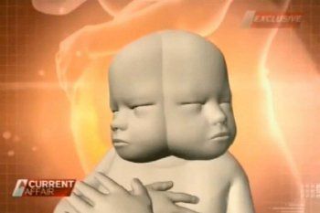 Renee Howie, Ibu dengan Calon Bayi 2 Wajah 1 Badan yang Tolak Aborsi