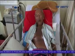 Kakek Terbakar Dadanya Saat Disinari
