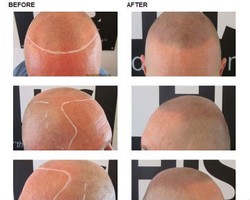 Frustasi Tidak Memiliki Rambut, Pria Ini Mentato Kulit Kepalanya