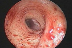 Berhari-hari Alami Nyeri Telinga, Ternyata Ada Belatungnya